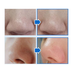 MEDIPEEL Extra Super 9 Plus Blackhead Out Nose Pack 5ea